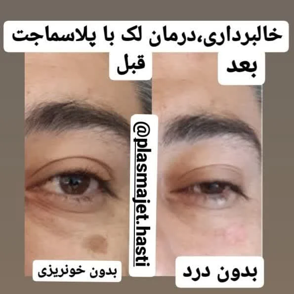 پلاسماجت لک صورت