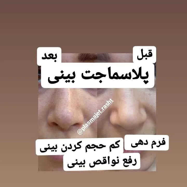 پلاسماجت بینی