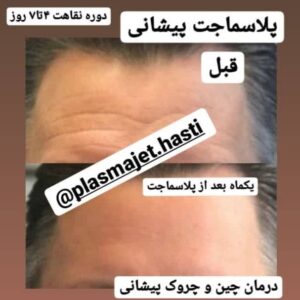 پلاسماجت پیشانی
