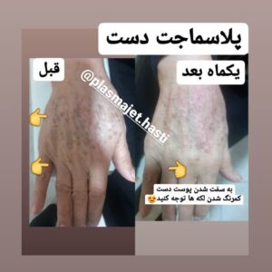 پلاسماجت دست