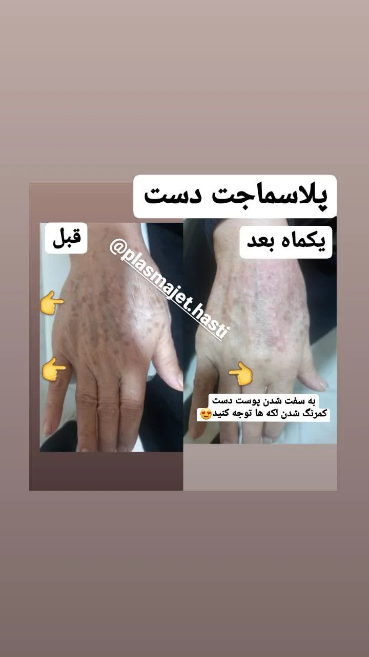 پلاسماجت دست