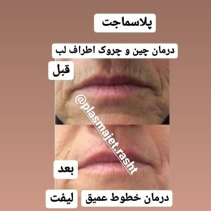 پلاسماجت اطراف لب