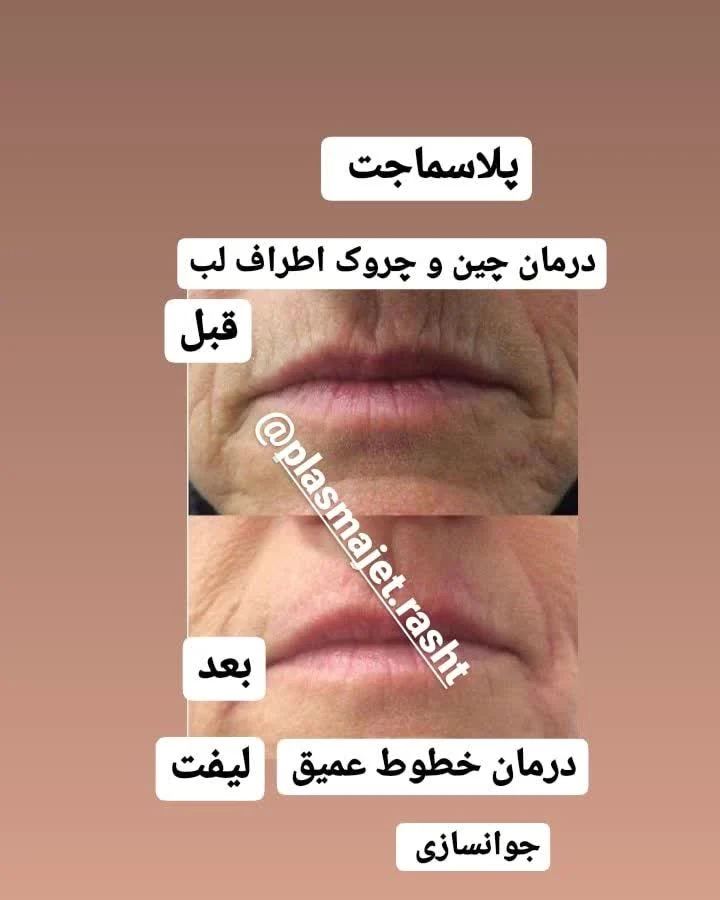 پلاسماجت اطراف لب