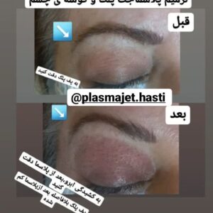 پلاسماجت پلک و گوشه چشم