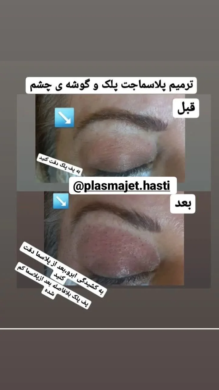 پلاسماجت پلک و گوشه چشم